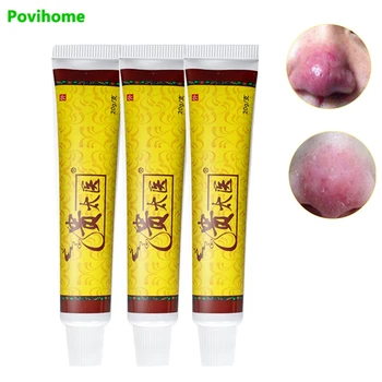 3pcs Rosacea Behandling Creme Anti Næse Mider Fjerne Røde Næse Hudorm Remover Formindske Porer Antibakterielle Salve Klør Gips