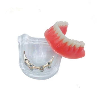 Protesen underkæbens Tænder model Overdenture implantat model med gyldne bar, Dental Pædagogiske Model