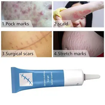 15g Scar Removal Cream Ansigt Til Ansigt Akne Ar strækmærker Remover Fløde Skin Repair Creme til Ansigtet Acne Pletter Facail Creme