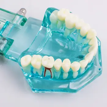 Dental Undersøgelse Tand Model Voksen Patologiske undervisning Tænder model nye denshine