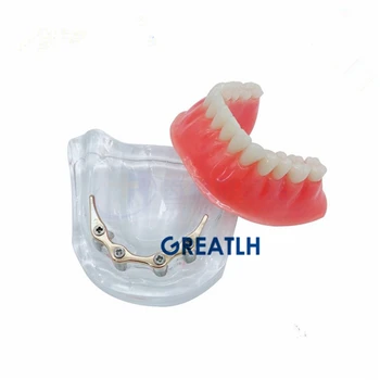 Protesen underkæbens Tænder model Overdenture implantat model med gyldne bar, Dental Pædagogiske Model
