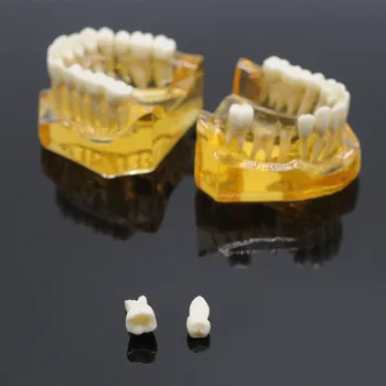 Dental Aftagelige Tænder Voksen Typodont Model Implantat Sygdom Tænder Tandlæge Lab Udstyr
