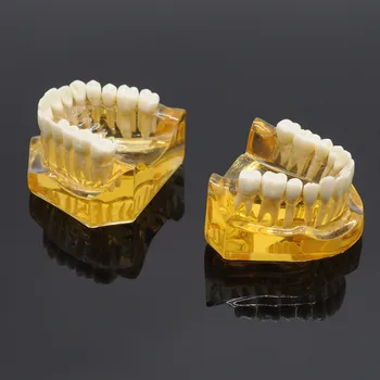 Dental Aftagelige Tænder Voksen Typodont Model Implantat Sygdom Tænder Tandlæge Lab Udstyr
