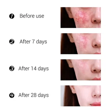 Acne Behandling Ansigtscreme Hudorm Repair Gel Oil Control Formindske Porer, Ar Kridtning Fugtighedscreme Huden Pleje Koreanske Kosmetik