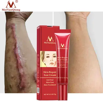 MeiYanQiong Ar Fjernelse Creme Acne Behandling Whitening Cream Fjerner Strækmærker Mørk Plet Bumser Ansigt Facial Cream Hud Pleje